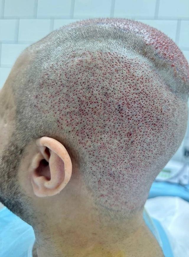 Популярный блогер Амиран Сардаров наконец-то решился на операцию по пересадке волос