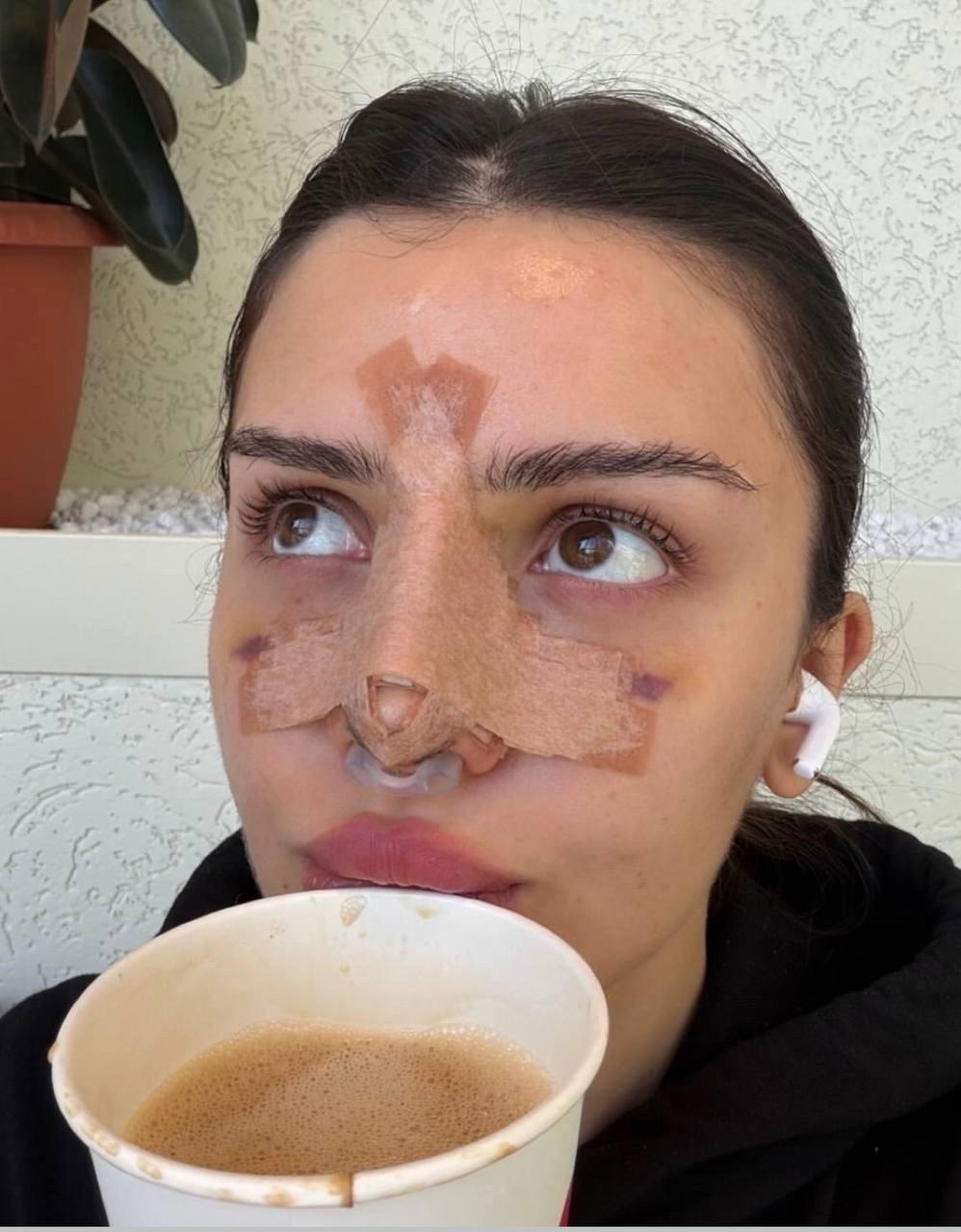 Дина Саева впервые продемонстрировала своё лицо после повторной операции на носу.