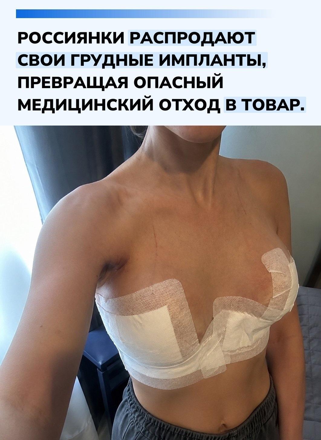 На сайтах объявлений появился по-настоящему тревожный тренд: женщины выставляют на продажу грудные импланты, удаленные после замены или операции