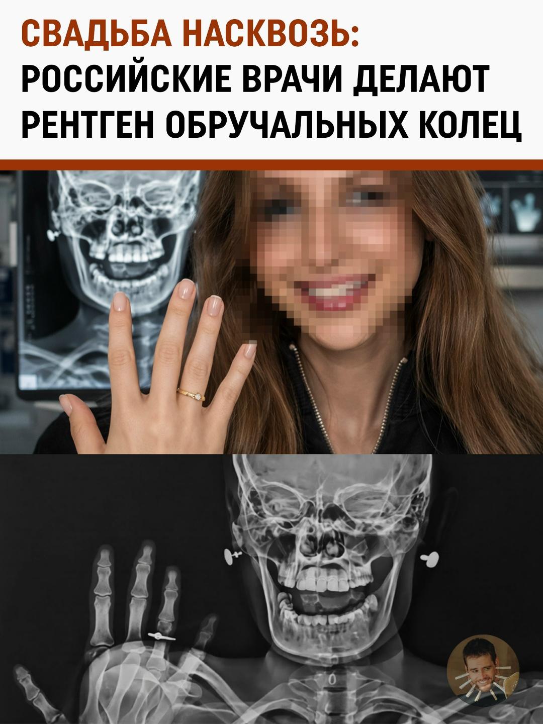 Тренд на эксклюзив: почему молодожены-медики делают снимки рентгена вместо фотосессий