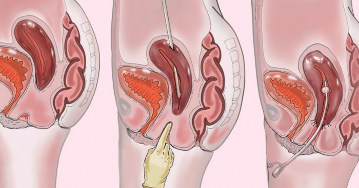 Британка, родившаяся без шейки матки и влагалища, естественно забеременела после реконструкции