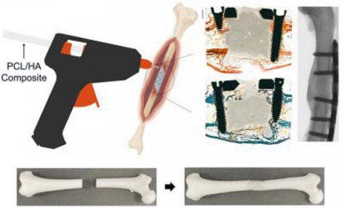 Ученые придумали мед-пистолет, который печатает новую кость при переломах