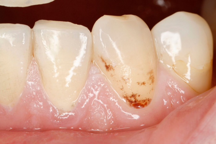 Врач Песчанская: застревание пищи между зубами может говорить о кариесе