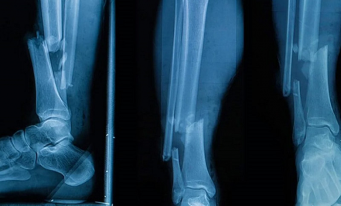 Ученые придумали мед-пистолет, который печатает новую кость при переломах